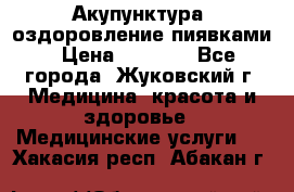 Акупунктура, оздоровление пиявками › Цена ­ 3 000 - Все города, Жуковский г. Медицина, красота и здоровье » Медицинские услуги   . Хакасия респ.,Абакан г.